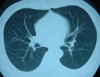 肺CT検査結果